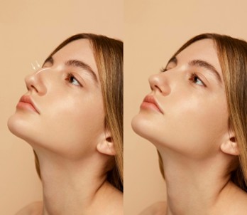 Mujer con rinoplastia luego de realizar turismo estético en Medellin
