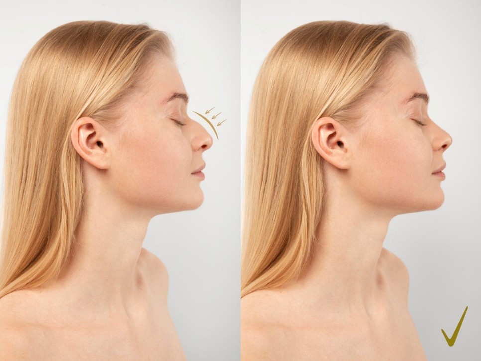 rinoplastia